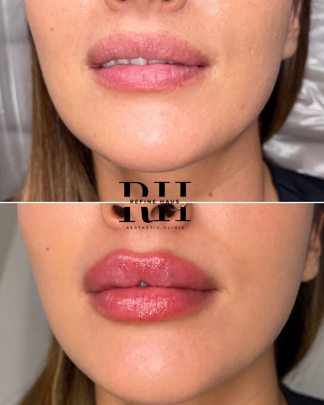 Balanced lip enhancement result using 1ml filler