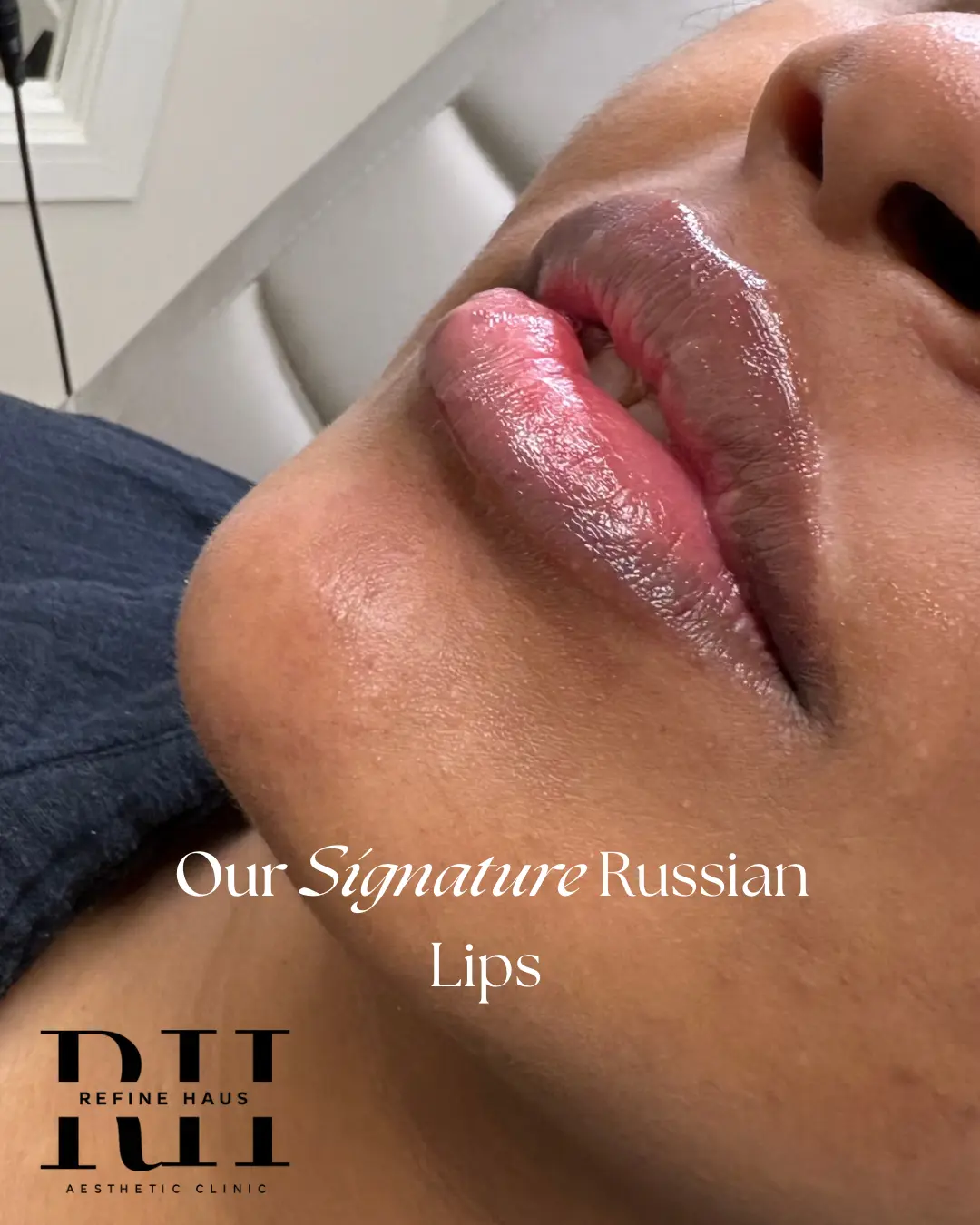 Before and after Russian lip enhancement using 1ml dermal filler