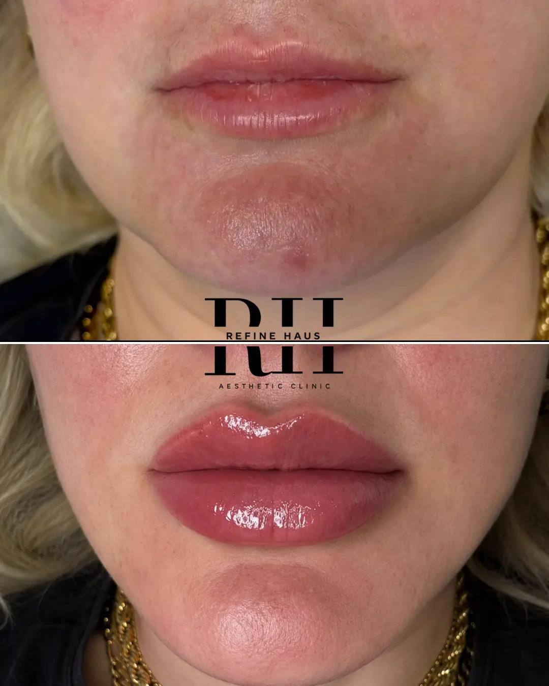 Natural-volume 1ml lip filler result