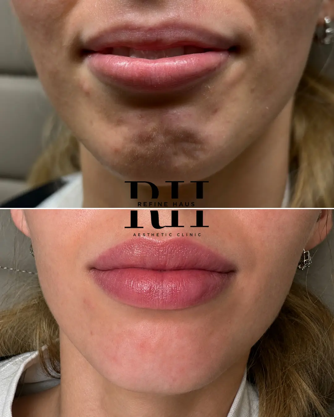 Before and after signature lip enhancement using 1ml dermal filler