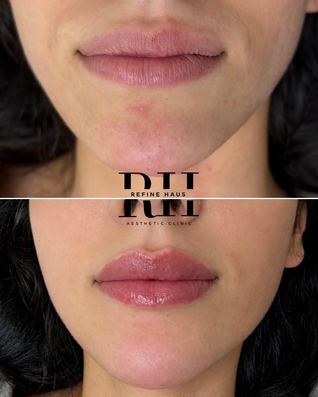 Before and after 1ml lip enhancement