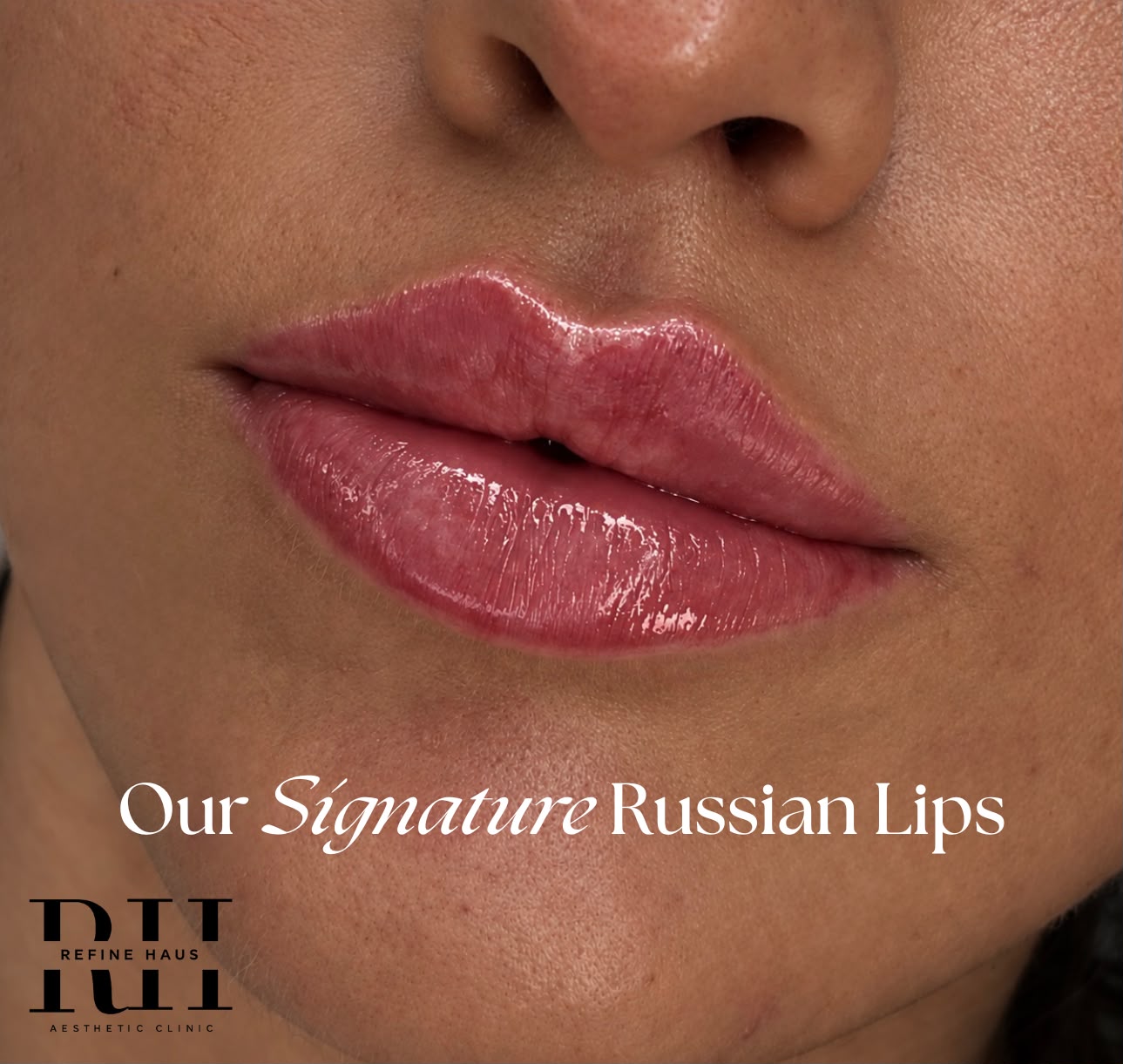 Front view of a balanced Russian lip enhancement result