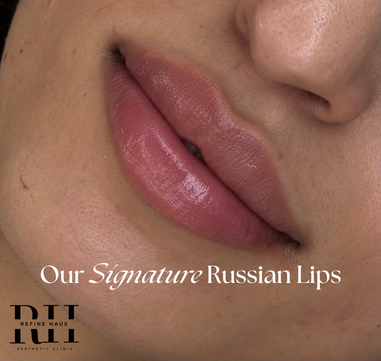 Softly defined Russian lip enhancement result