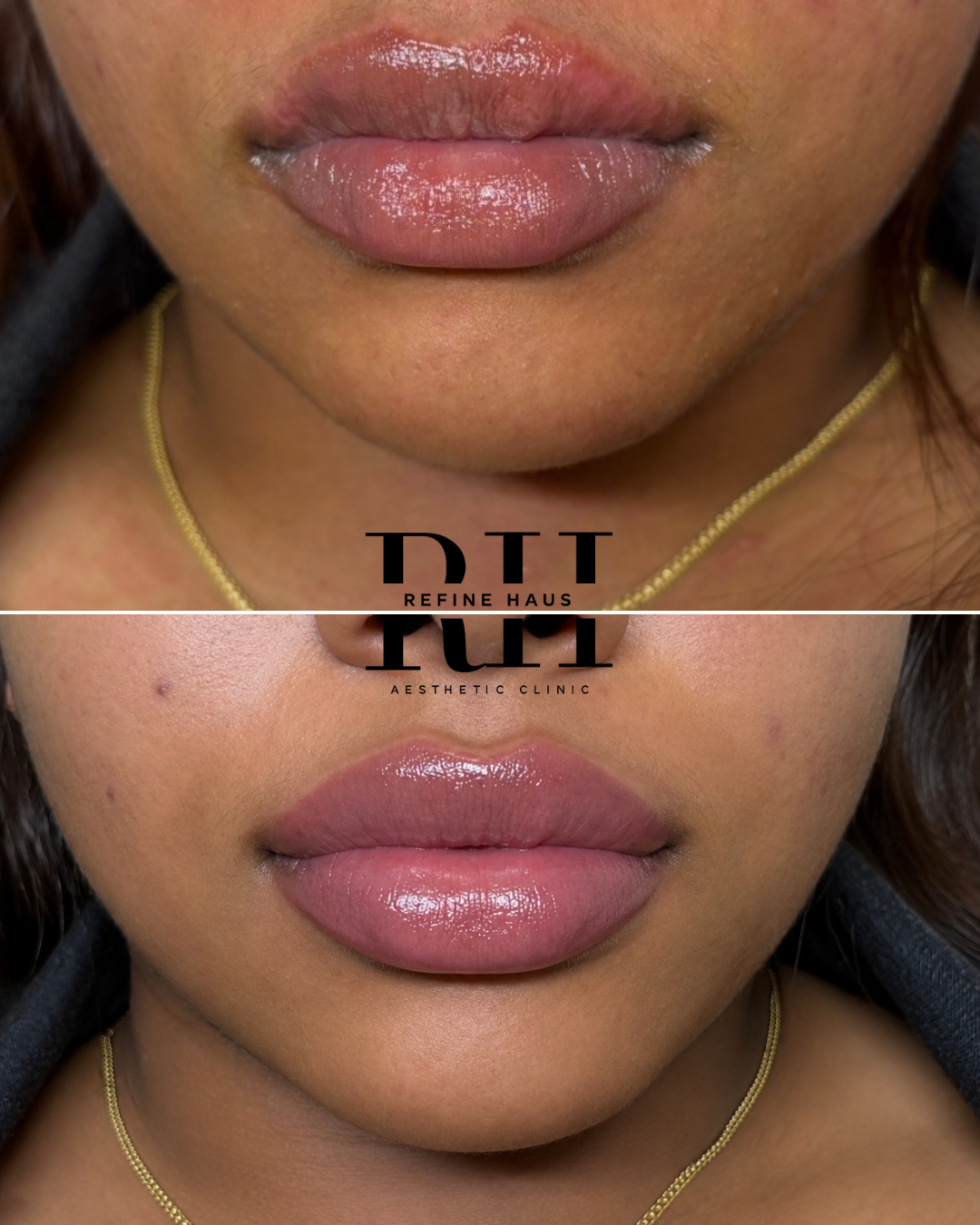 Lip shape and definition after 1ml dermal filler