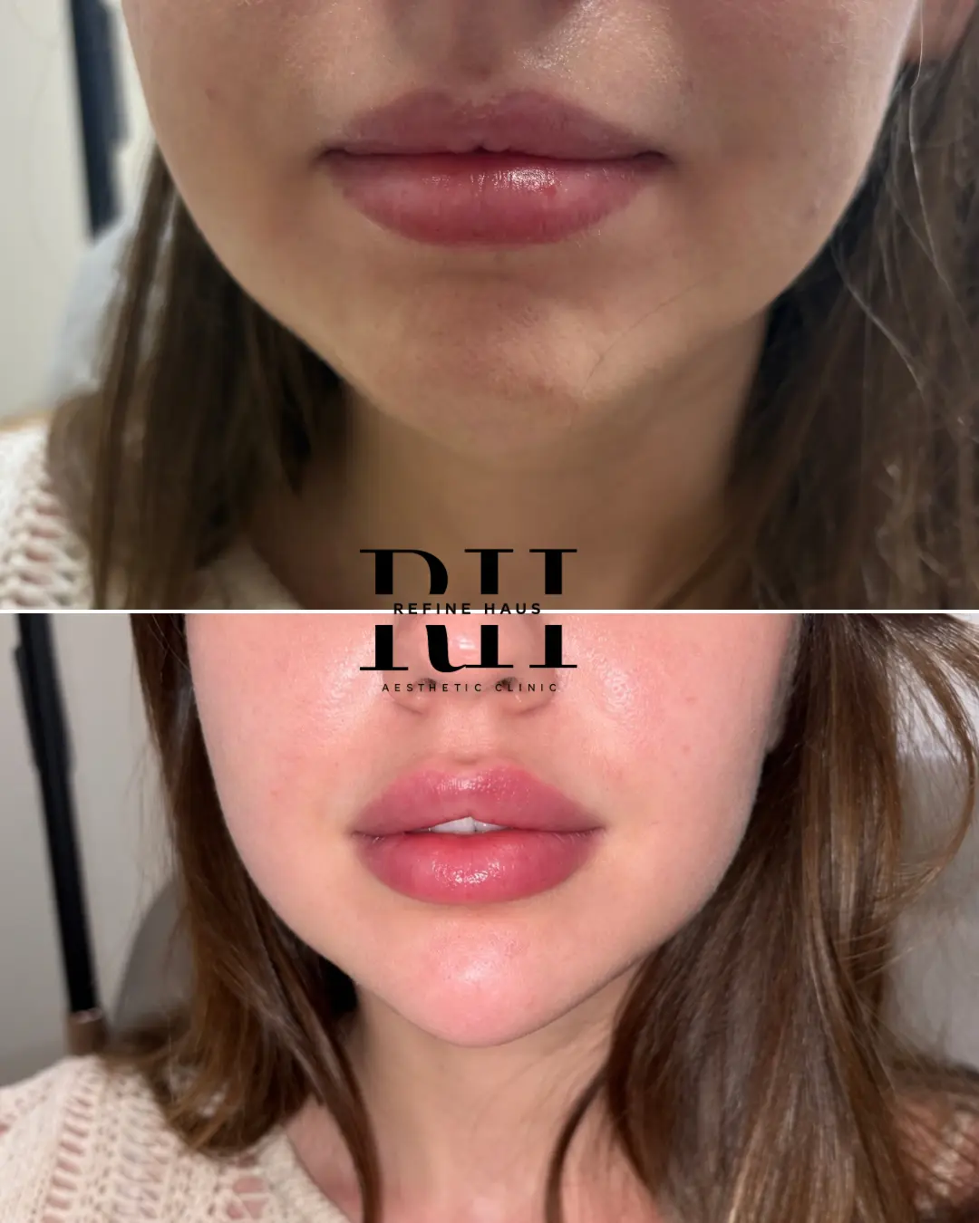 Before and after lip and chin enhancement using 2ml dermal filler