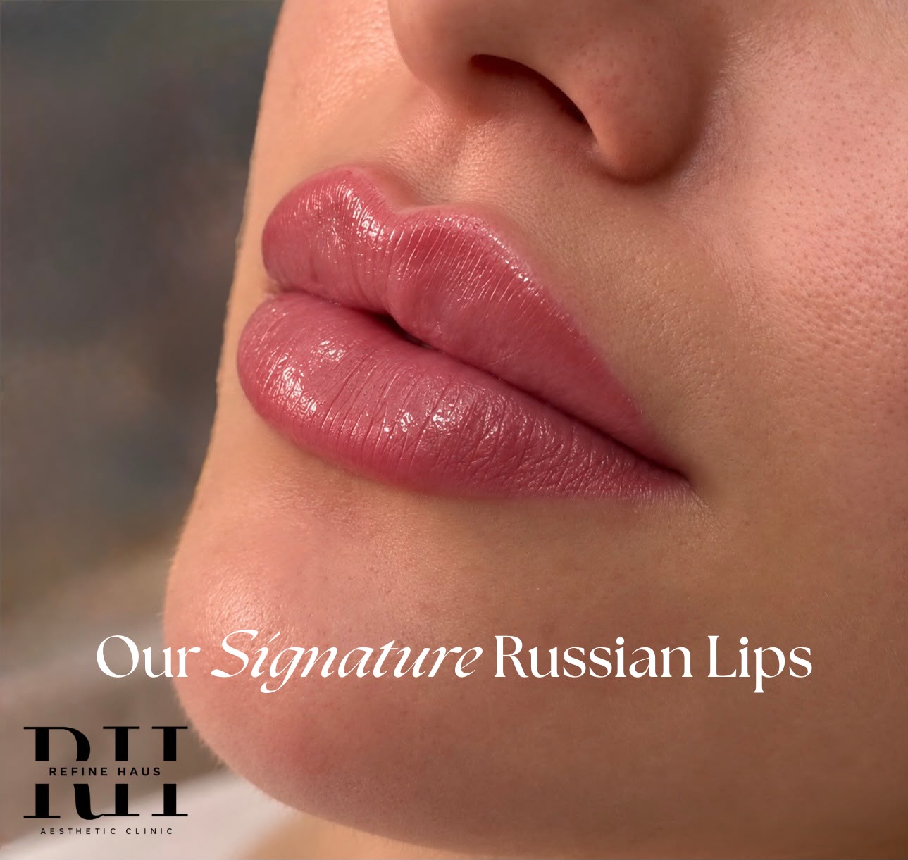 Defined cupid’s bow after Russian lip enhancement