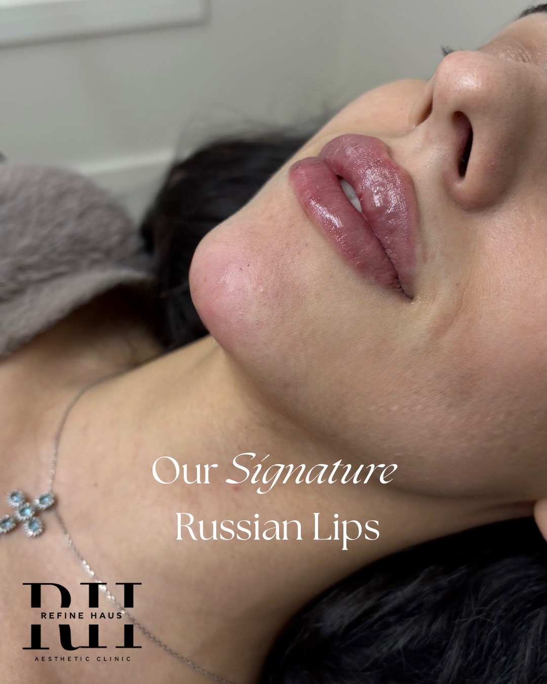 Profile view after signature Russian lip enhancement