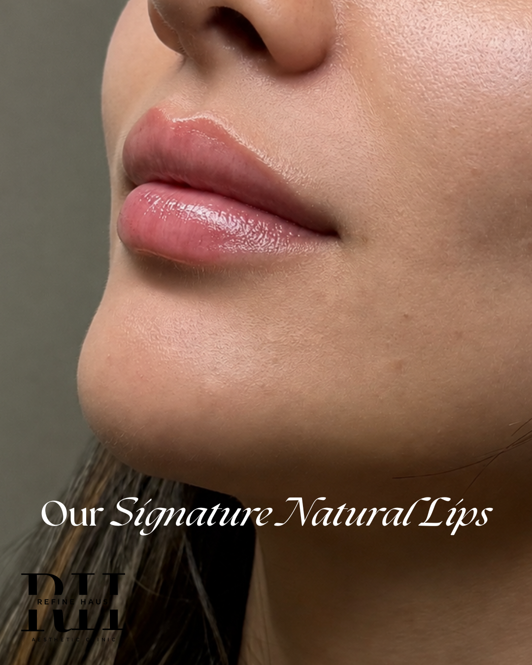 Before and after natural lip enhancement using 0.5ml dermal filler