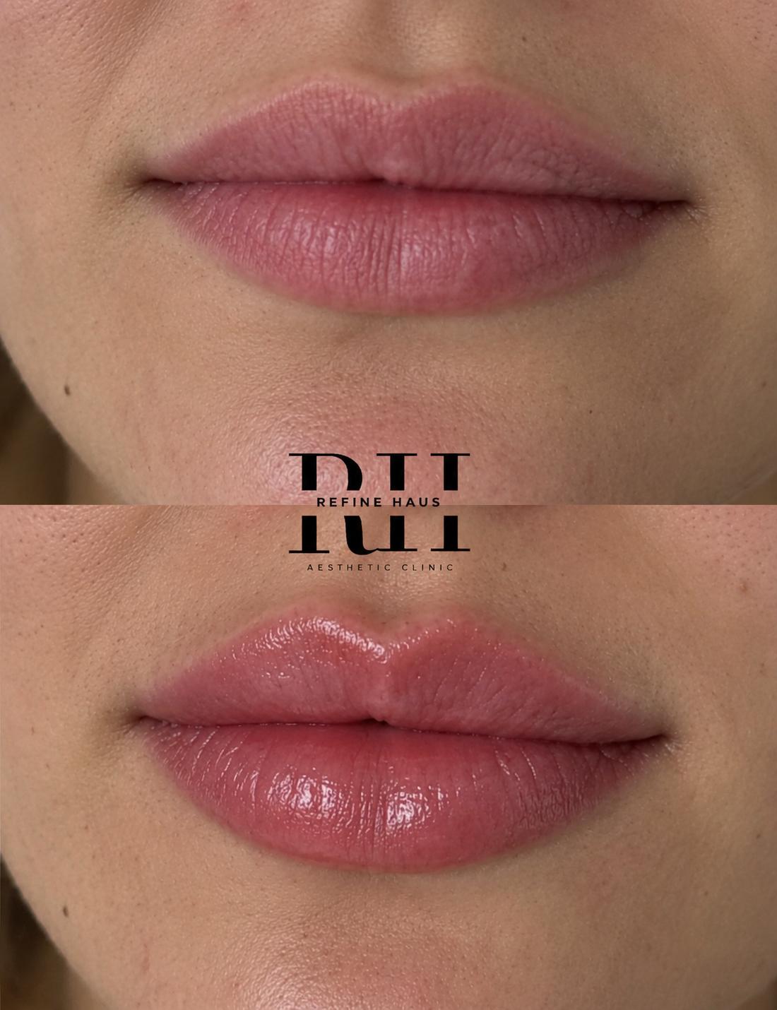 Defined lip enhancement result using 1ml filler