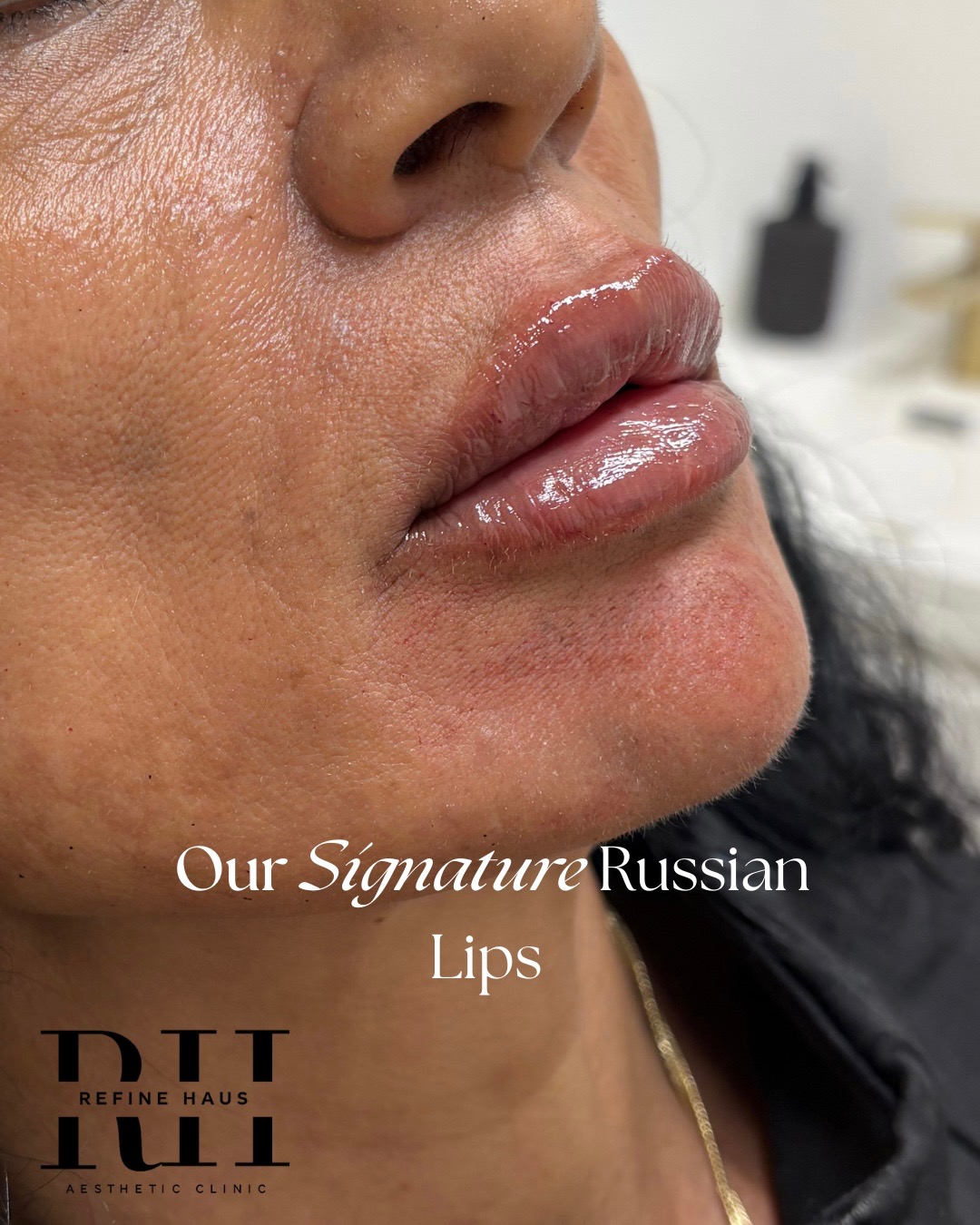 Side profile after 1ml Russian lip enhancement