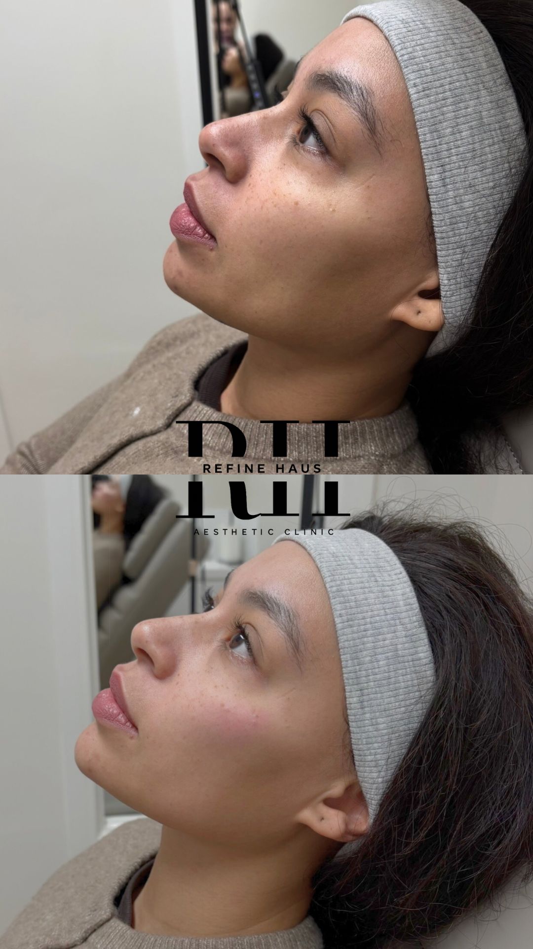 Before and after chin, jawline and cheek filler