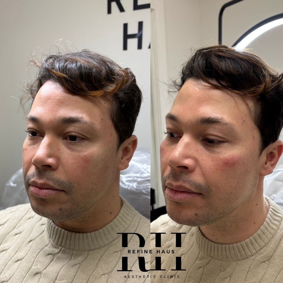 Before and after jawline chin and cheek filler