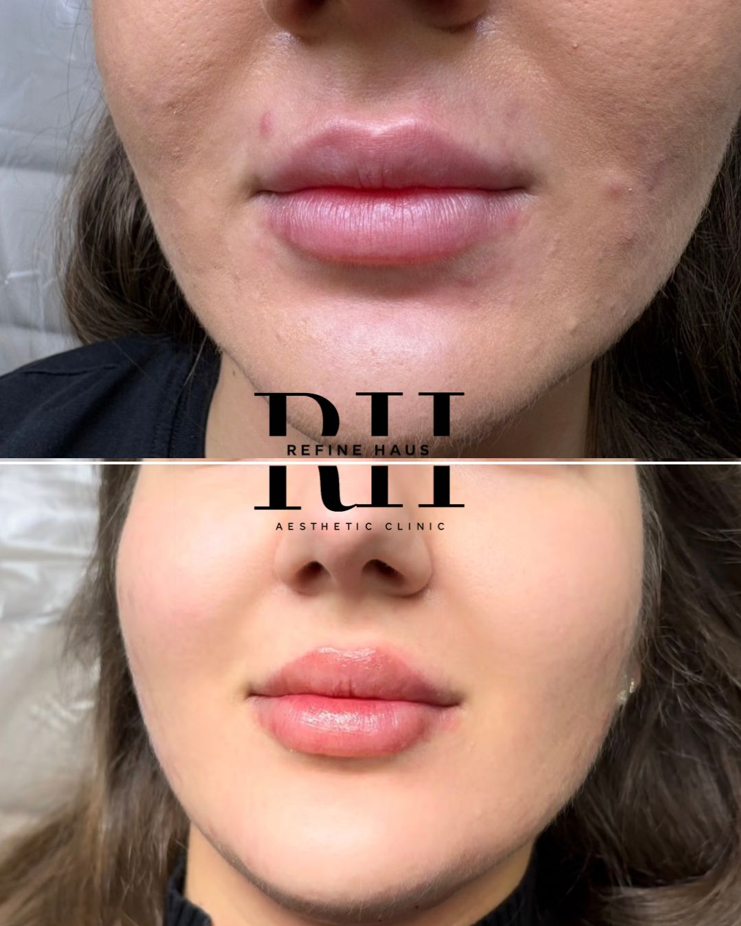 Before and after 1ml lip enhancement at Refine Haus