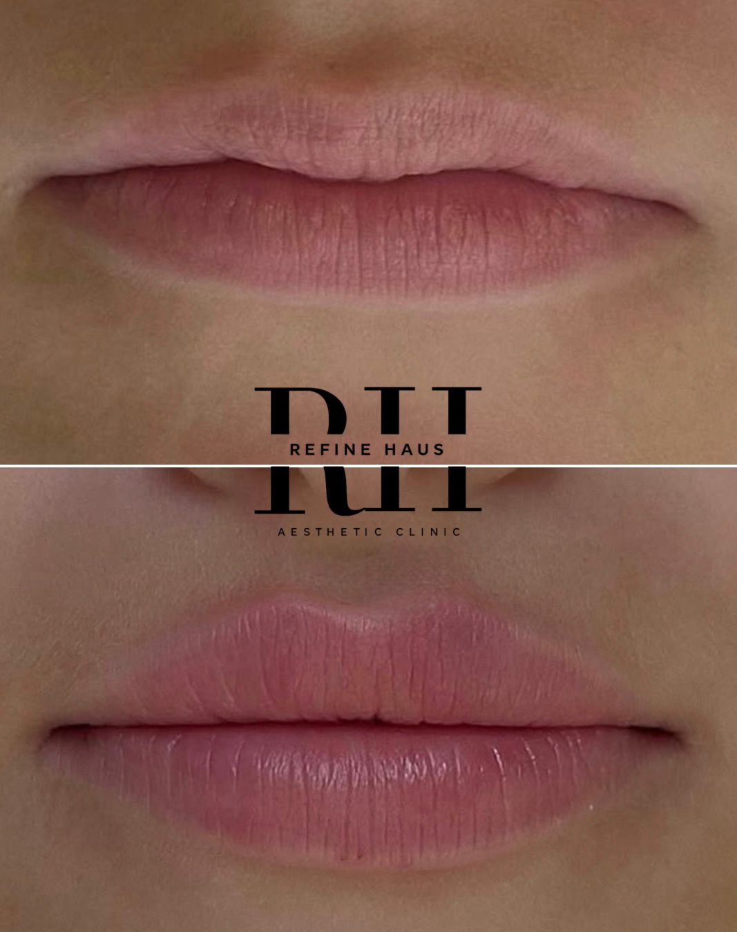 Before and after 1ml lip filler