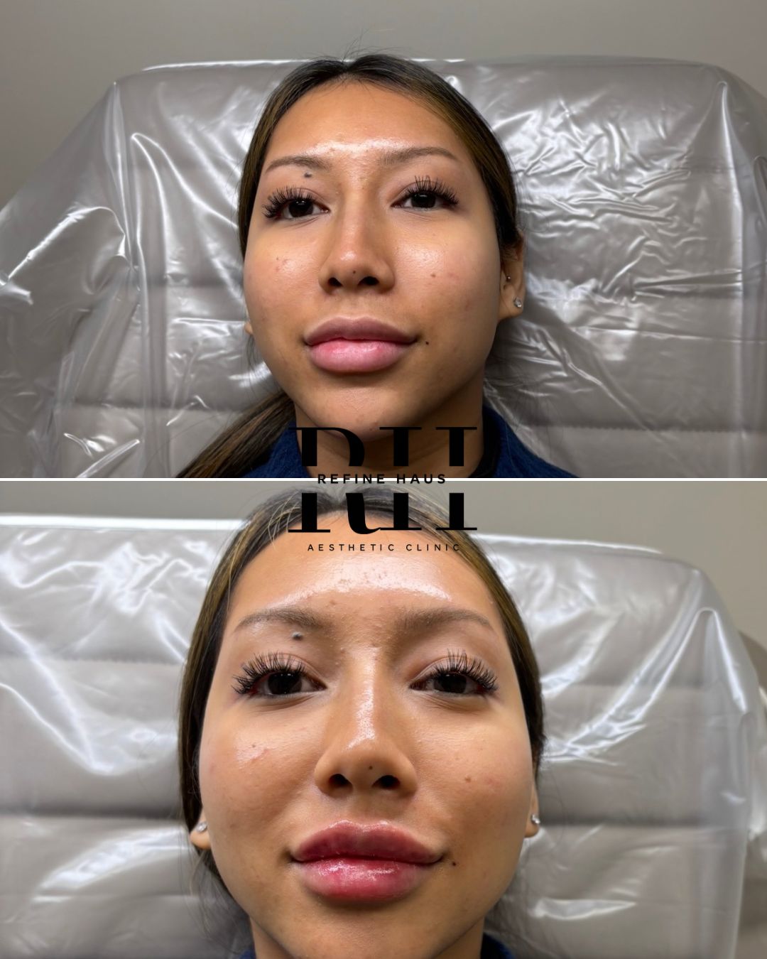 Before and after lip filler enhancement